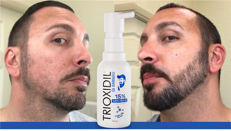 Minoxidil 15% - Trioxidil - Fórmula 3x mais Potente.